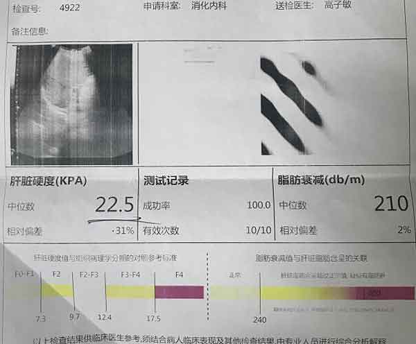 郑州肝硬化治疗好的医院在哪里