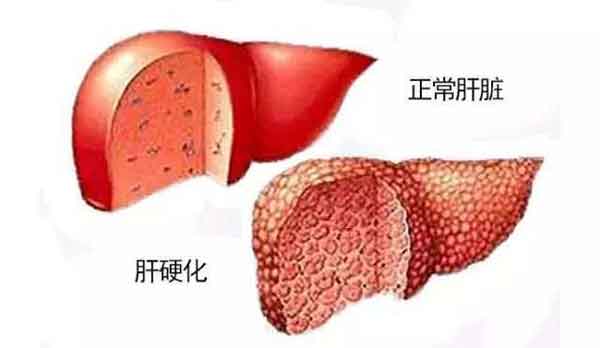 郑州哪家治疗乙肝大三阳医院好