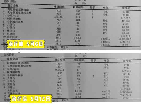 郑州哪家治疗乙肝大三阳医院好